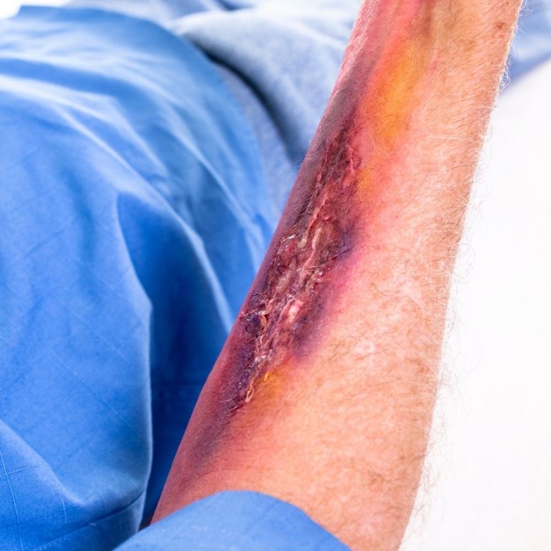 San Diego Burn Injury Lawyer